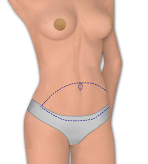Abdominal Donor Tissue