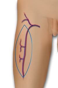 Marking the ALT Flap