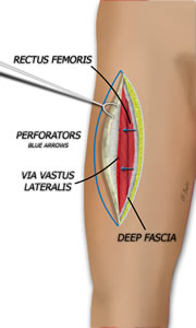 The Flap is Outline