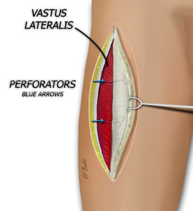 The Anterior Flap is Dissected