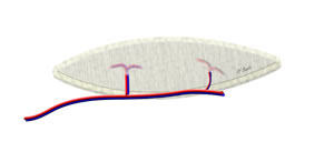 The Perforator and Pedicle are Dissected