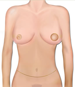 Skin Sparing Reconstruction