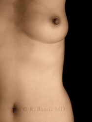 Breast Restoration with Microsurgery