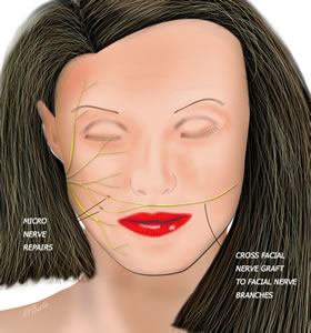 Cross Facia Nerve Grafting