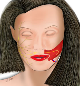 Anterior View of the Inset Flap