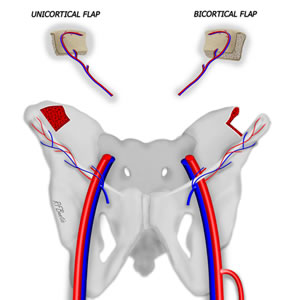 Full or Partial Thickness Iliac Crest