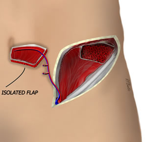 The Flap is Isolated
