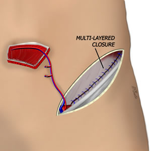 The Donor Area is Closed