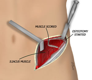 The Osteotomies are Made