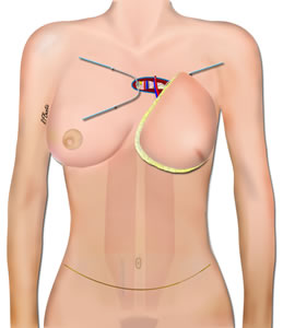 DIEP Anastomosis