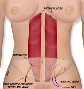 Anatomy of the DIEP Flap