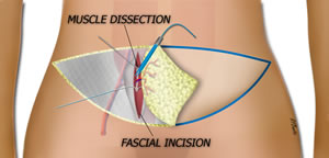 Elevating the DIEP fFlap