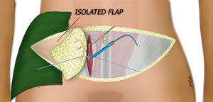 Elevating the DIEP Flap