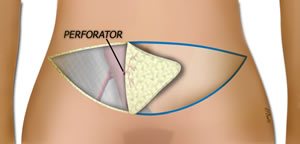 Identifying the Major Perforator
