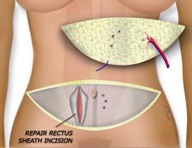The Harvested Diep Flap