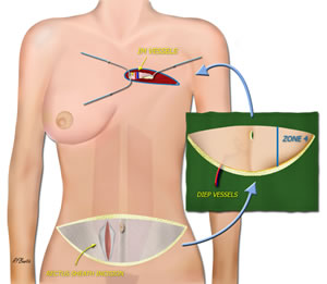DIEP Flap Harvested