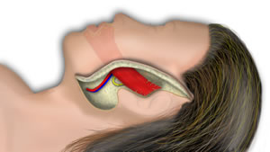 The Muscle is Inset and Vascularized