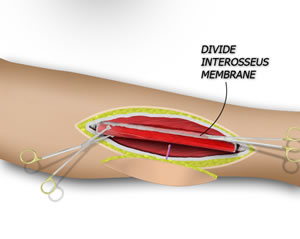 The Osteotomies are Performed