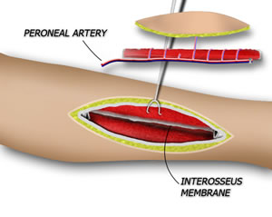 The Osteotomies are Performed