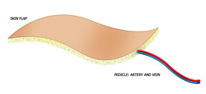Conventional Flap
