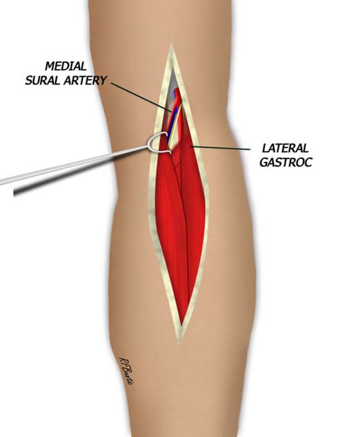 The Proximal Gastroc is Exposed