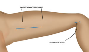 Marking the Incision