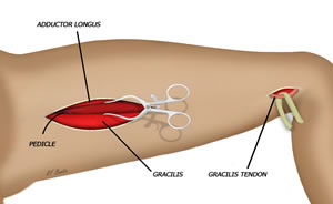 The Pedicle is Found