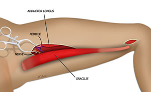 The Gracilis Muscle is Isolated