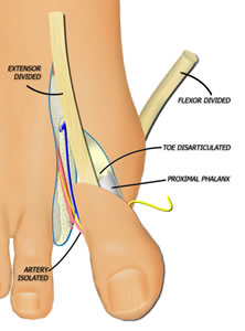 The Toe is Isolated