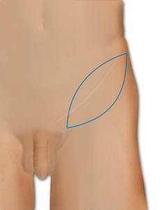 The Incision is Marked