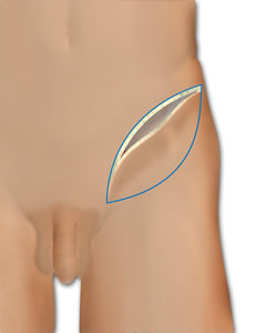 The Superior Medial Incision is Made