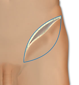 The Superior Medial Incision is Made