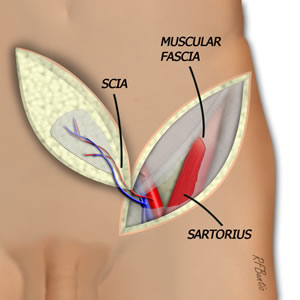 The Flap is Elevated