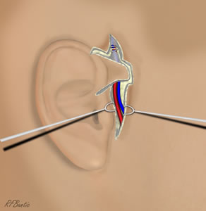 The Proximal Pedicle is Found