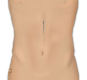 The Incision