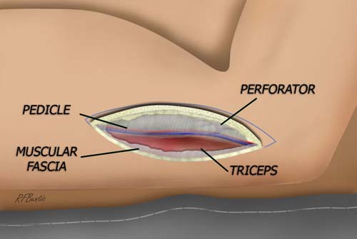 Elevating the Posterior Flap