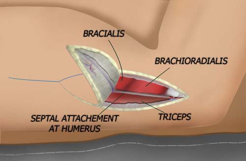 Elevating the Distal Flap