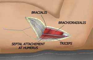 Elevating the Distal Flap