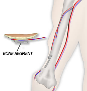 Osteocutaneous Lateral Arm Flap