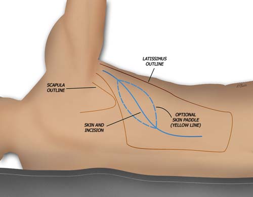 Positioning and Incisions