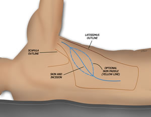 Positioning and Incisions