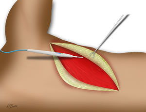 Skin Flap Elevation