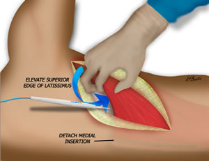Superior Edge of Muscle Identified