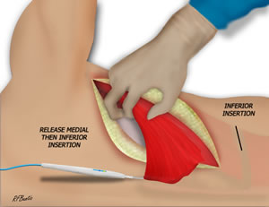 Flap is Detatched Distally