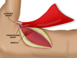 Flap is Removed