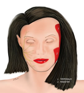 Muscles of Mastication