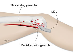 Medial femoral condyle flap