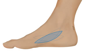 The Flap is Outlined