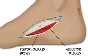 The Flap is Elevated Beginning on the Plantar Aspect