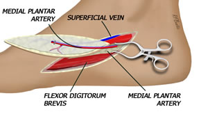 The Flap is Isolated